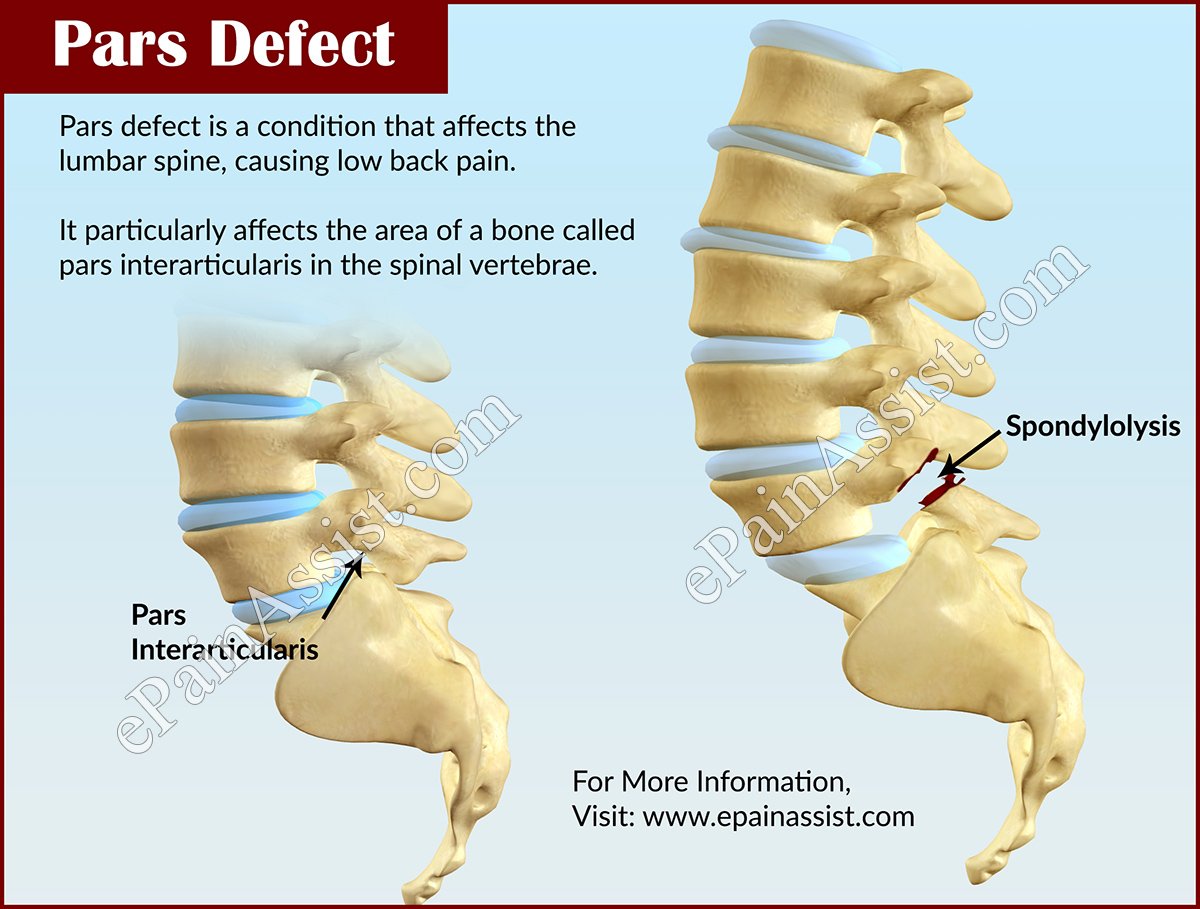 Unilateral or Bilateral defect in Pars Interarticularis