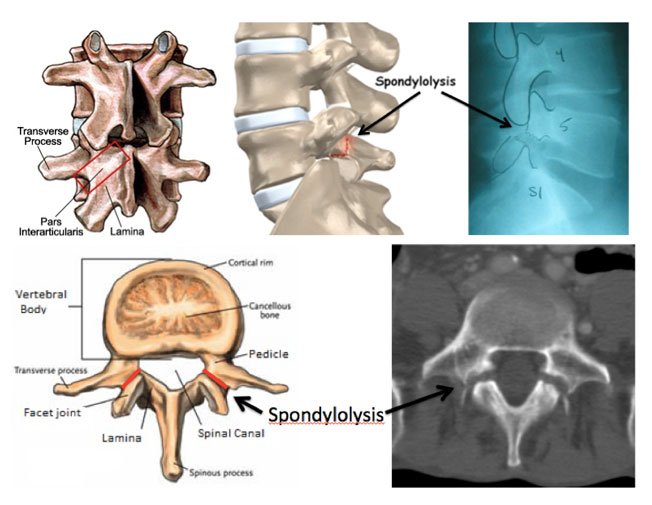 Traumatic Lumbar Spondylolisthesis