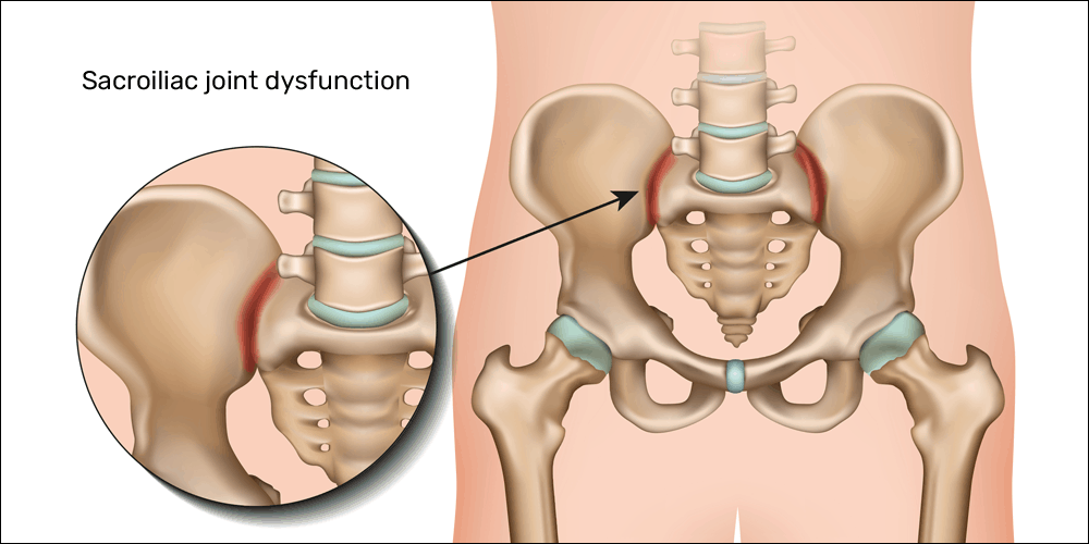 Sacroiliac Joint Dislocation