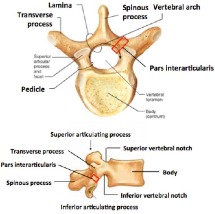 Traumatic Lumbar Locked Facet Syndrome