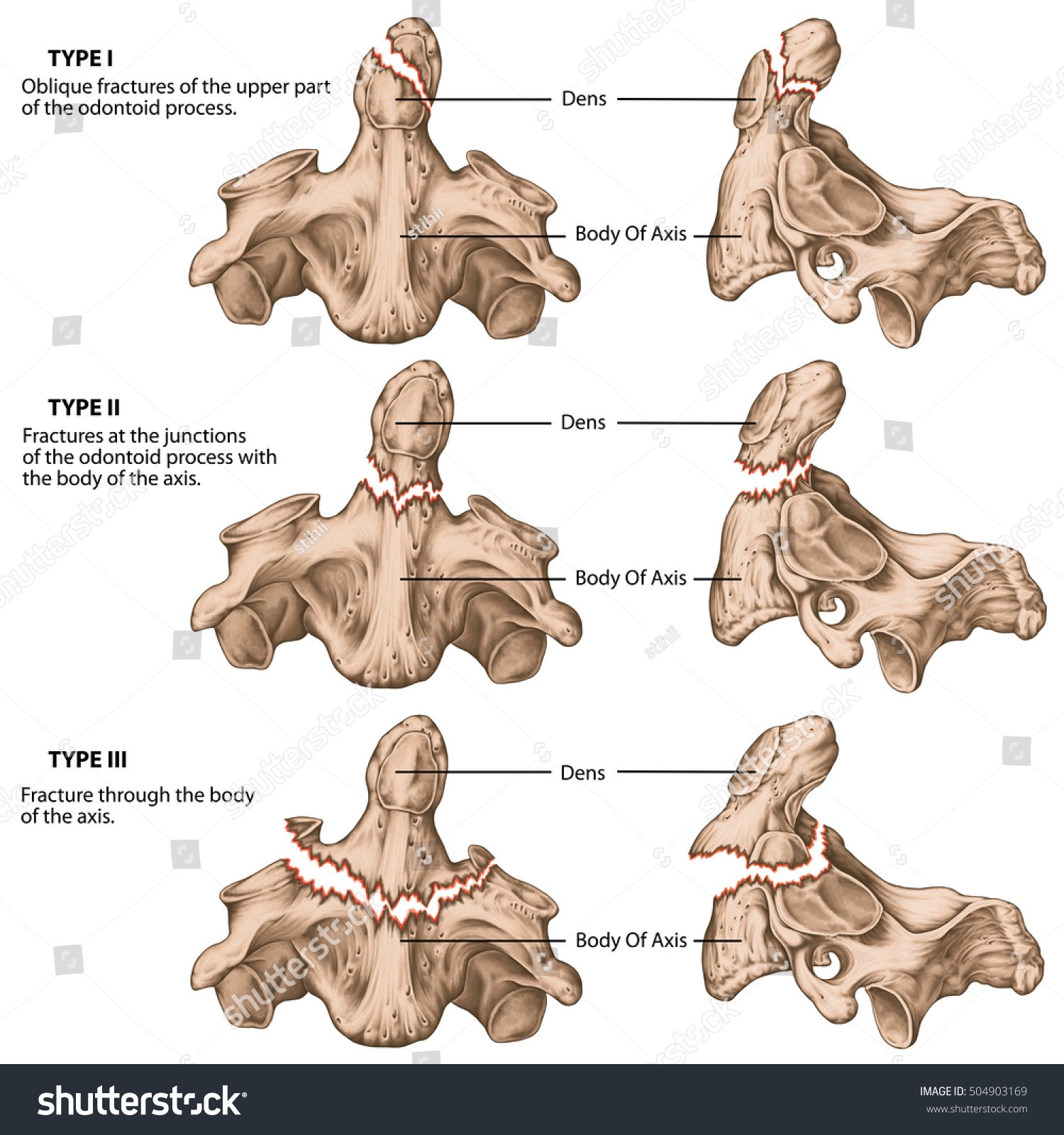 Test Diagnosis of Odontoid Fracture