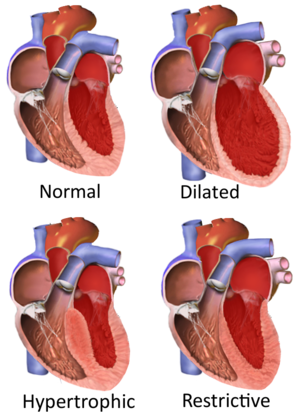 Ischemic Cardiomyopathy