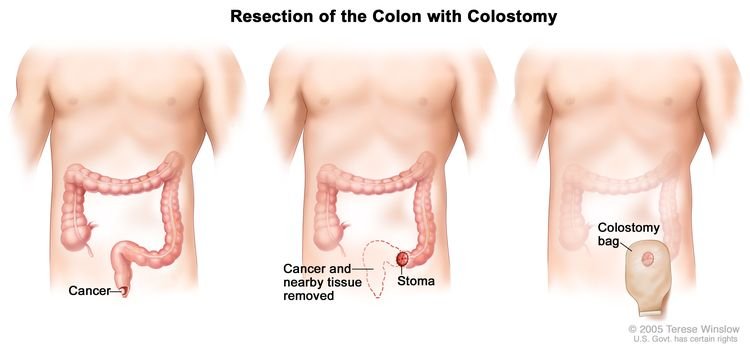 Anal Cancer/Cancers of the anal canal are rare, comprising approximately 10% of malignancies in the anorectal region, although its incidence has been increasing over the past several decades.