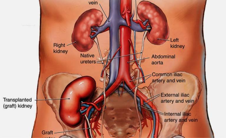 kidney transplant