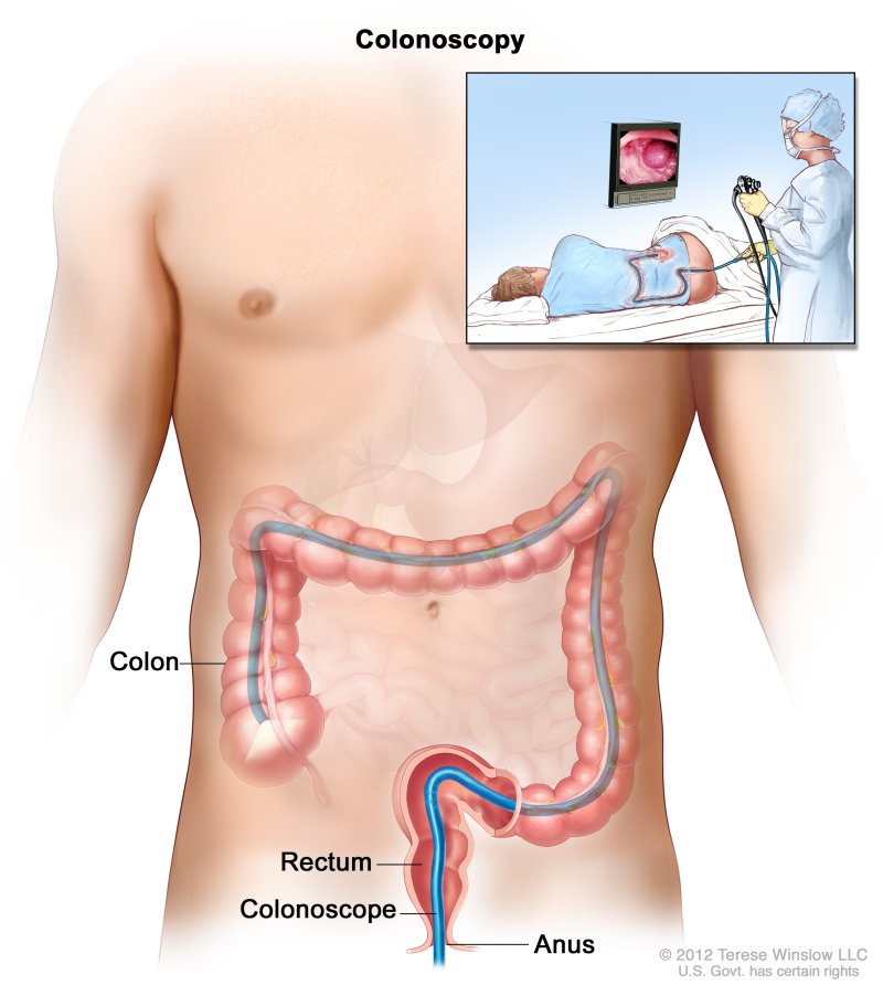 Rectum Cancer