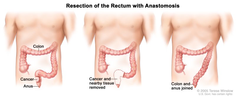 Rectum Cancer