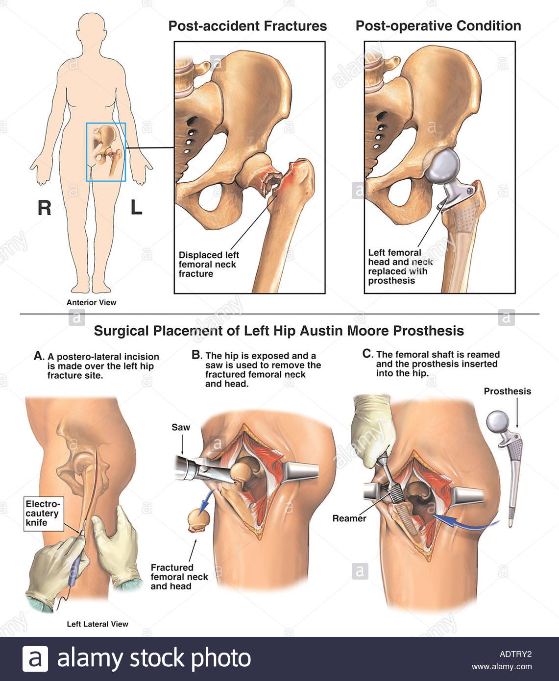 Osteonecrosis of Hip