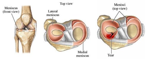 Medial Meniscus Injury