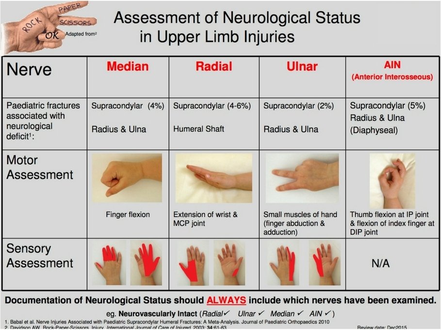 Median Nerve Palsy