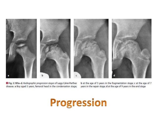 Osteonecrosis of Hip