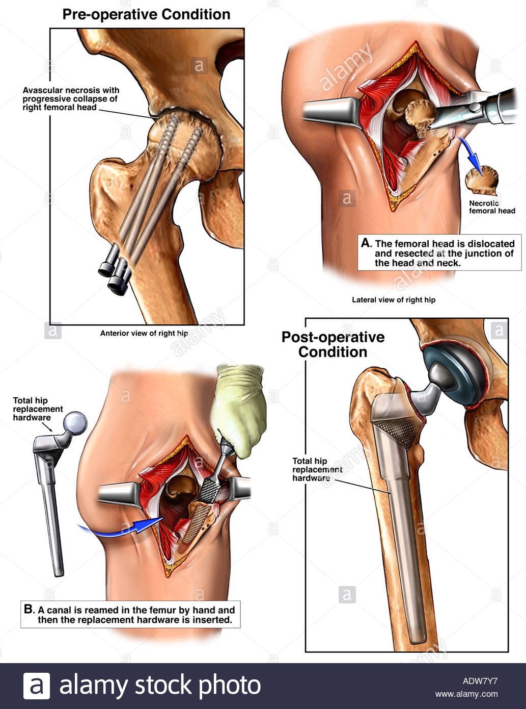Osteonecrosis of Hip