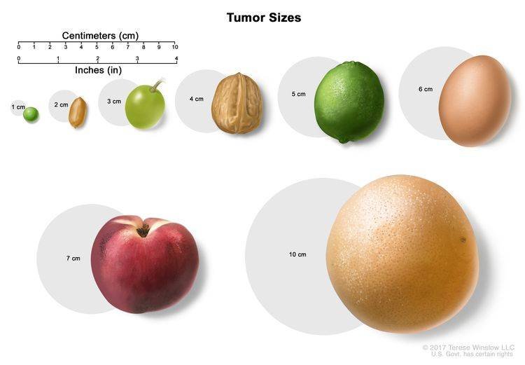 Soft Tissue Sarcomas