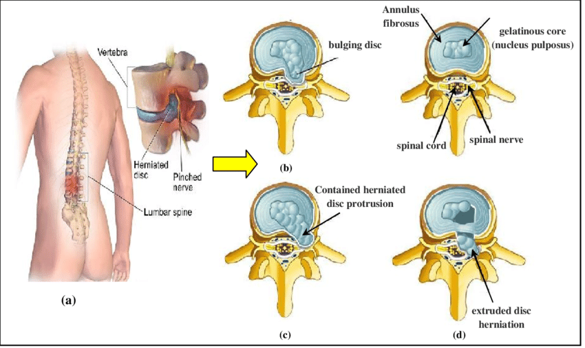 Posterior Disc Bulging