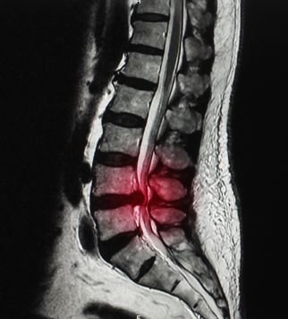 Typical findings of solitary nerve lesion due to compression by a herniated disc in the cervical spine C5 Nerve - neck, shoulder, and scapula pain, lateral arm numbness, and weakness during shoulder abduction, external rotation, elbow flexion, and forearm supination. The reflexes affected are the biceps and brachioradialis. C6 Nerve - neck, shoulder, scapula, and lateral arm, forearm, and hand pain, along with lateral forearm, thumb, and index finger numbness. Weakness during shoulder abduction, external rotation, elbow flexion, and forearm supination and pronation is common. The reflexes affected are the biceps and brachioradialis. C7 Nerve - neck, shoulder, middle finger pain are standard, along with the index, middle finger, and palm numbness. Weakness on the elbow and wrist are common, along with weakness during radial extension, forearm pronation, and wrist flexion may occur. The reflex affected is the triceps. C8 Nerve - neck, shoulder, and medial forearm pain, with numbness on the medial forearm and medial hand. Weakness is common during finger extension, wrist (ulnar) extension, distal finger flexion, extension, abduction, and adduction, along with distal thumb flexion. No reflexes are affected. T1 Nerve - pain is common in the neck, medial arm, and forearm, whereas numbness is common on the anterior arm and medial forearm. Weakness can occur during thumb abduction, distal thumb flexion, and finger abduction, and adduction. No reflexes are affected.